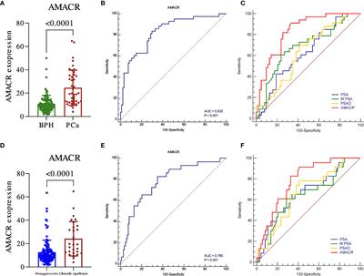 Urine Exosomal AMACR Is a Novel Biomarker for Prostate Cancer Detection at Initial Biopsy